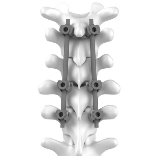 頸椎-胸椎骨接合システム - C.T.J - NEURO FRANCE Implants - 後方進入