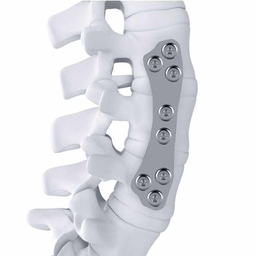腰椎関節固定プレート - ARTHEMIS - NEURO FRANCE Implants - 胸椎-腰椎 / 前側面 / チタン製