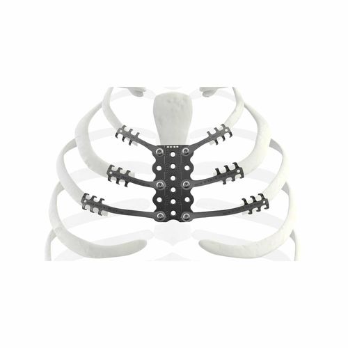 骨肉腫の切除後の再建用肋骨用プロテーゼ - TRIONYX® - NEURO FRANCE Implants