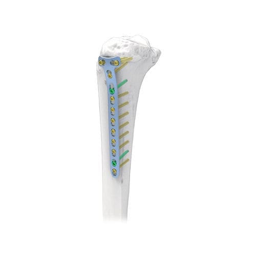 脛骨用圧迫プレート - T - NORMMED Medical Devices - ロッキング / 金属製