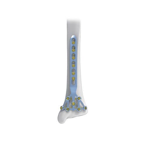 脛骨用圧迫プレート - Pilon - NORMMED Medical Devices - ロッキング / 金属製