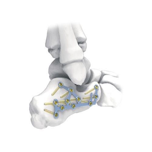 踵骨用圧迫プレート - PNM1032 - NORMMED Medical Devices - ロッキング / 金属製