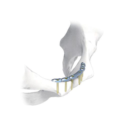 骨盤用圧迫プレート - NORMMED Medical Devices - ロッキング / 金属製