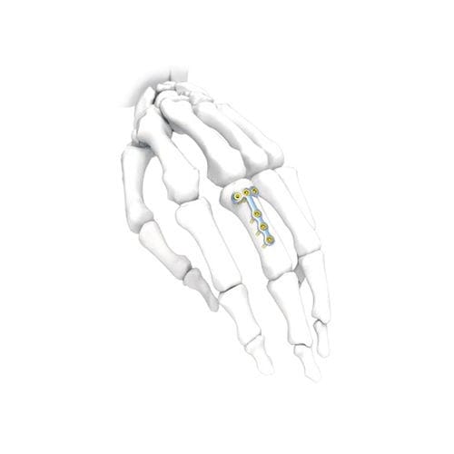 手用圧迫プレート - PNM5004 - NORMMED Medical Devices - ロッキング / 金属製