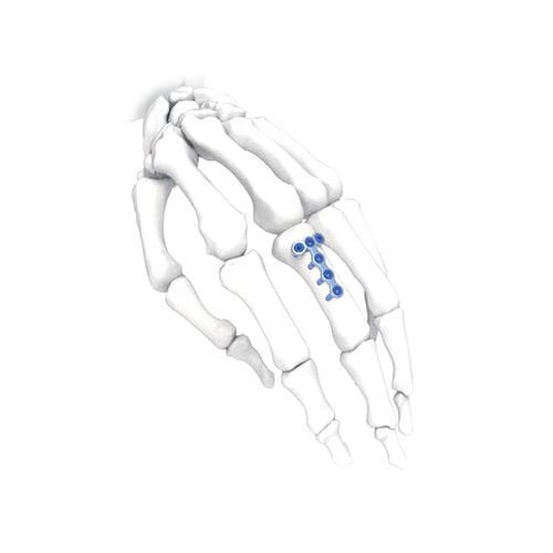 手用圧迫プレート - PNM5009 - NORMMED Medical Devices - ロッキング / 金属製