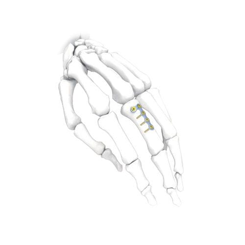 手用圧迫プレート - L  - NORMMED Medical Devices - ロッキング / 金属製