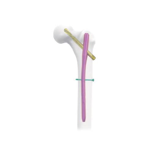 大腿骨用髄内釘 - NORMMED Medical Devices - 転子用 / 金属製