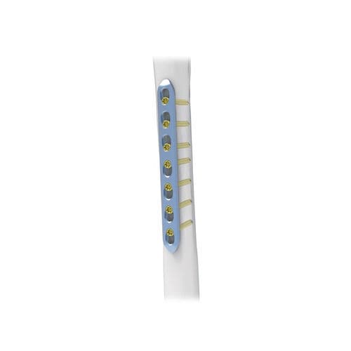 小骨片用圧迫プレート - NORMMED Medical Devices - ロッキング / 金属製