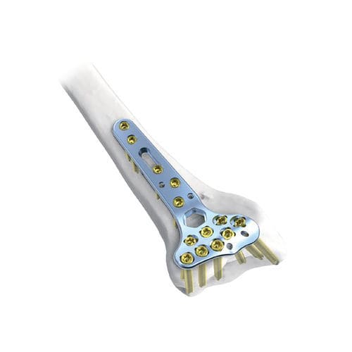 橈骨用圧迫プレート - Rim  - NORMMED Medical Devices - 末端 / ロッキング / 金属製
