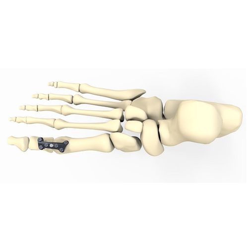 外反母趾用関節固定プレート - FRC20 series - Aleda Medical - ロッキング / 金属製