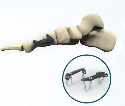 外反母趾用関節固定プレート - FRC200 series - Aleda Medical - ロッキング / 金属製