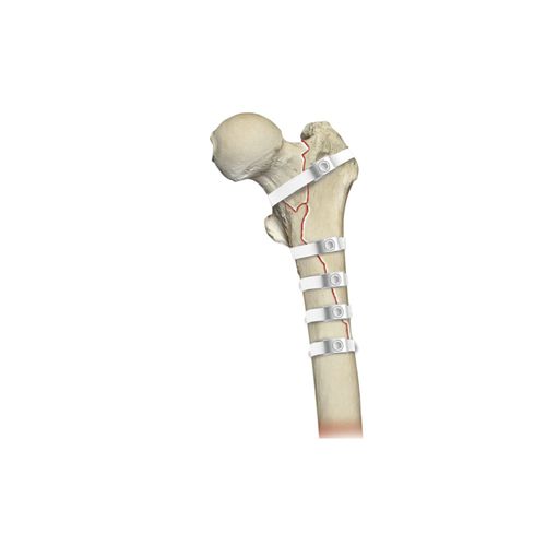 人工股関節置換手術用骨締結用ワイヤー - Ortholox® UHMWPE