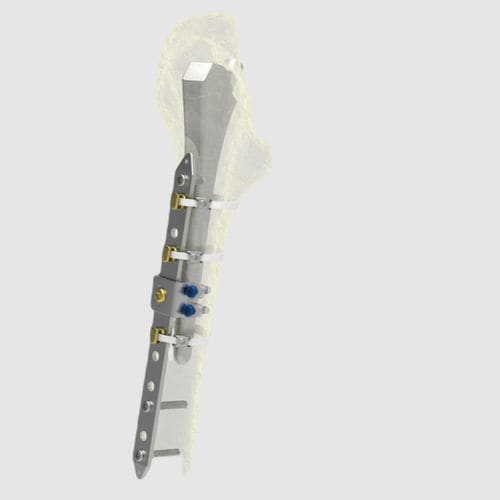 大腿骨人工関節周囲骨折用圧迫プレート - Ortholox® - Ortolog Medikal