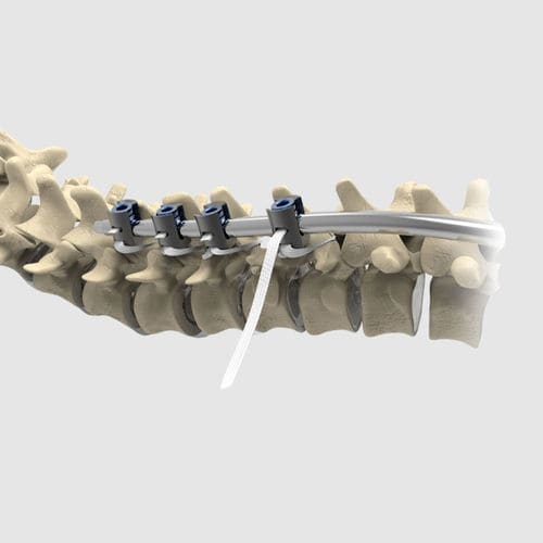 小児用背骨後方固定バンド - Ortholox&reg; UHMWPE - Ortolog Medikal