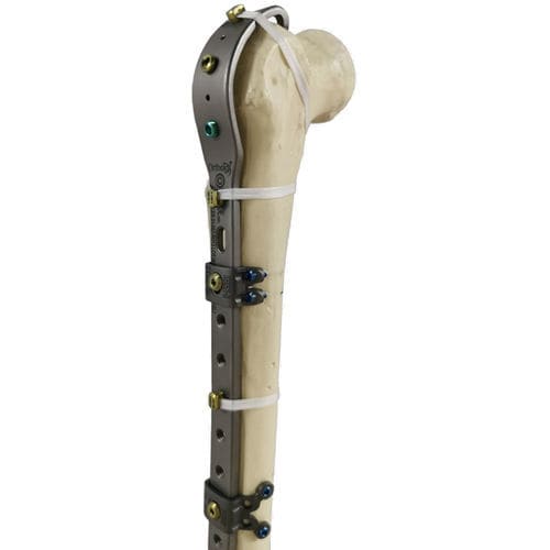 大腿骨人工関節周囲骨折用圧迫プレート - Ortholox®  - Ortolog Medikal - 近位部 / 末端 / ロッキング