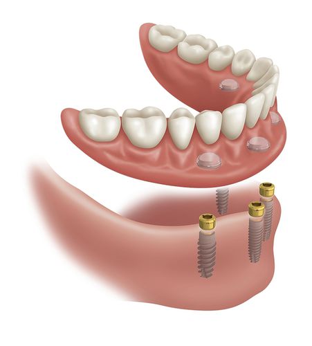 チタン製歯科インプラント - LOCATOR® - Zest Dental Solutions - 幅の