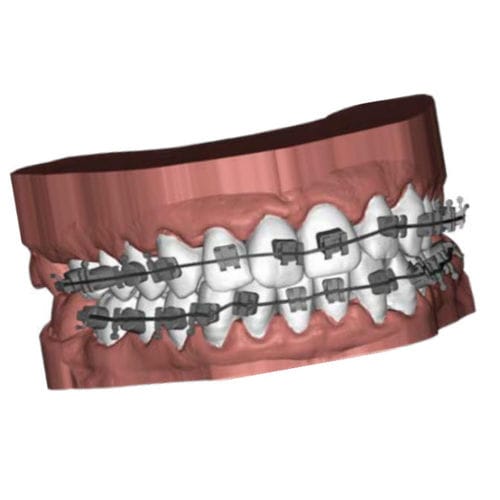 CADソフト - Ubrackets - Coruo - 3Dプリント / 歯列矯正 / Windows