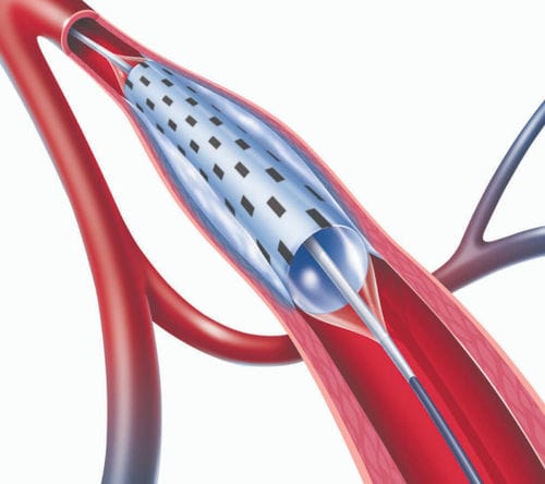 PTAカテーテル - PolarCath  - Nucryo Vascular - 鎖骨下動脈 / 大腿動脈用 / 回腸動脈