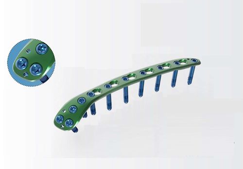 上腕骨用圧迫プレート - TRUE LOCK Distal Humerus Posterolateral - Truemed Medical - 末端 / 後外側 / ロッキング