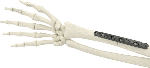 橈骨用圧迫プレート - PK-SCP2704-TI - WishBone Medical - 内側 / 金属製 / 子供用