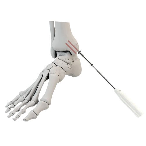 くるぶし用関節固定ねじ - WishBone Medical - カニューレ / チタン製 / 皮質