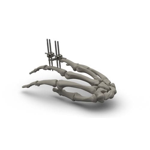 モジュール式外部固定システム - TASARIMMED - 中手指節関節用 / 筒状