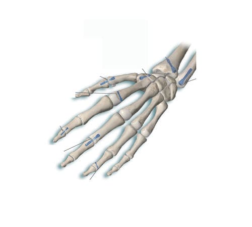 中手指節関節用圧縮骨ねじ - Delphos Implants - 指骨用 / ヘッドなし / 金属製
