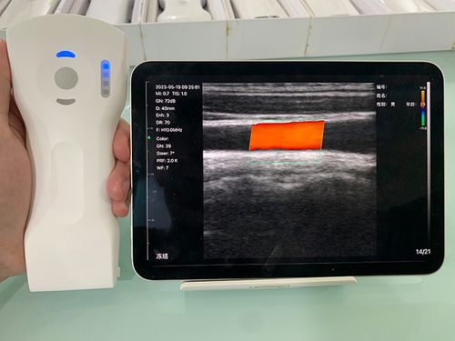 手持ち式超音波装置 - CL - Beijing iTrason Technologies - 婦人・産科超音画像診断用 / 腹部・骨盤超音画像診断用 / 泌尿器科超音波画像診断用