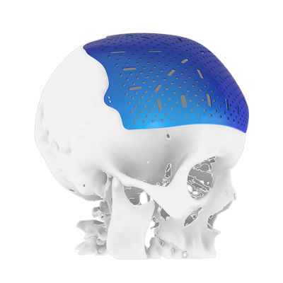 オーダーメイド頭蓋インプラント - Osteophoenix