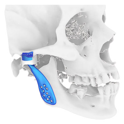 オーダーメイド顎関節用インプラント - Osteophoenix