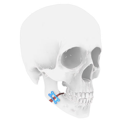 下顎骨用骨切りプレート - Osteophoenix - チタン製