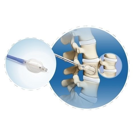 経皮的椎体形成術用器具一式 - FWS-007 series - Chongqing FWS Medical Device