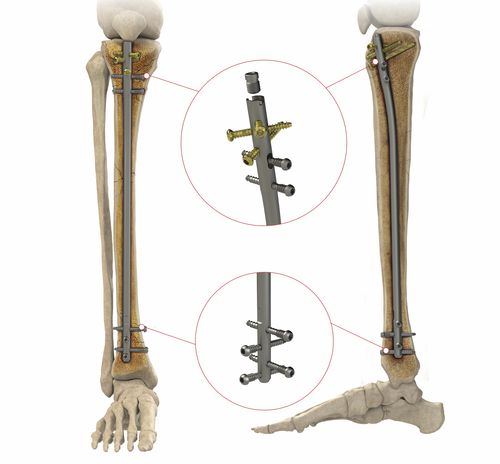 脛骨用髄内釘 - AS.ATN.401 - Ases Orthopedics - 近位固定 / 遠位固定 / チタン製