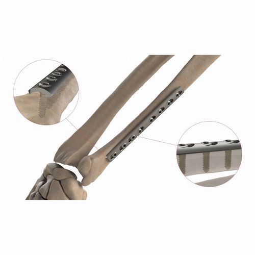 橈骨用圧迫プレート - AS.ST.064 - Ases Orthopedics - 尺骨用 / 内側 / ノンロッキング