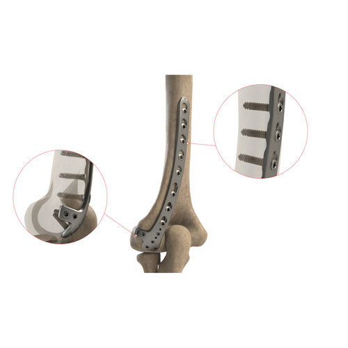 上腕骨用圧迫プレート - AS.E.022 - Ases Orthopedics - 末端 / 後外側 / ロッキング