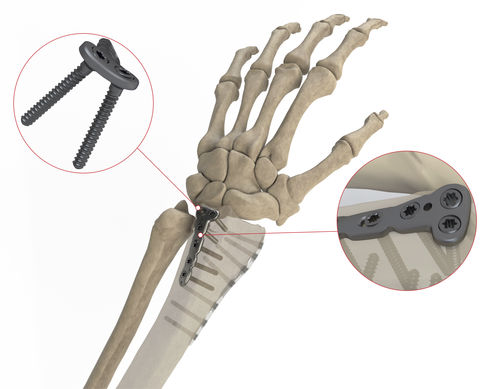 橈骨用圧迫プレート - L Shape DR Posterior  - Ases Orthopedics - 末端 / ロッキング