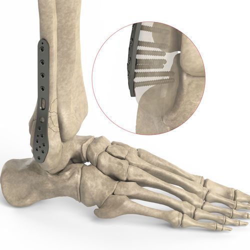 腓骨用圧迫プレート - Ases Orthopedics - 末端 / 側面 / ロッキング