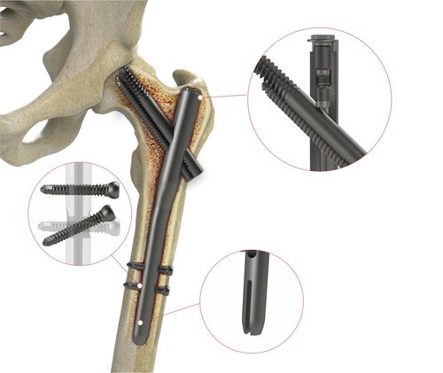 大腿骨用髄内釘 - 4T1-40310170 - Ases Orthopedics - 近位固定