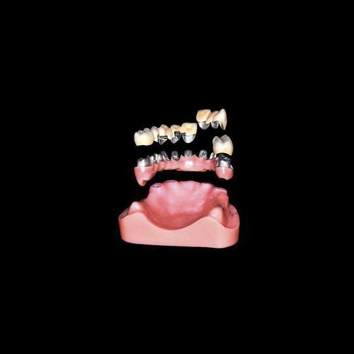 スクリューシリンダータイプ - Shenzhen Alcadent Co.Ltd Alcadent Dental Laboratory - 金属製 / ストレートタイプ / 歯科研究所用