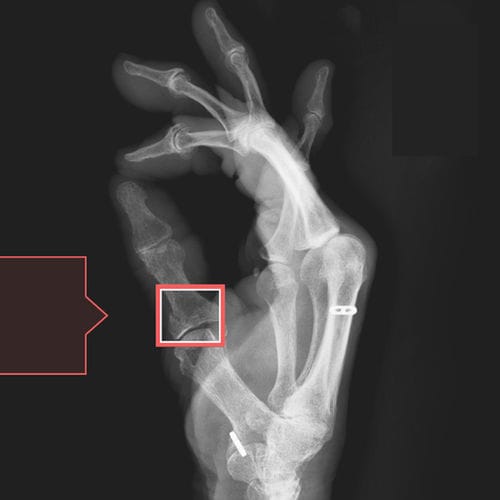 骨折検出ソフト - RBfracture™ - Radiobotics - 分析 / 可視化 / 診断用