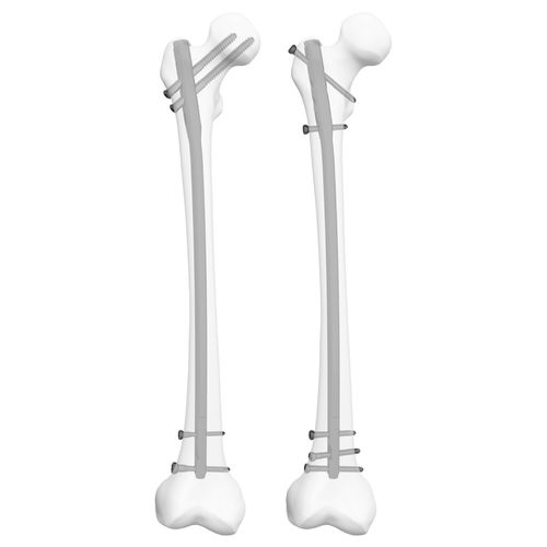 大腿骨用髄内釘 - 305009  - Boneunion Medical - 近位固定 / 遠位固定 / 右