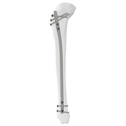 脛骨用髄内釘 - 305014 series - Boneunion Medical - 近位固定 / 遠位固定 / 右