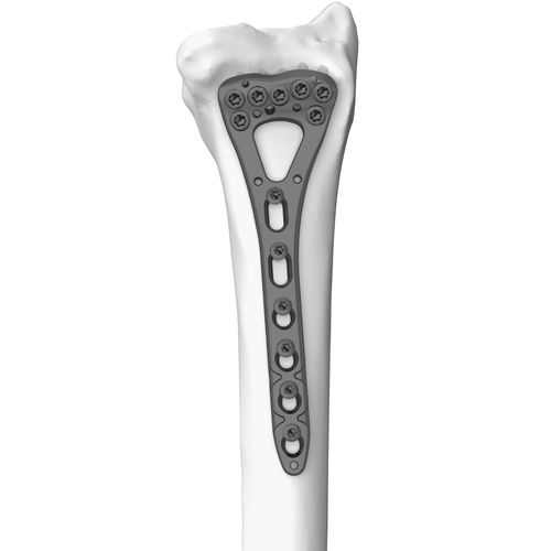 橈骨用圧迫プレート - 301077 series - Boneunion Medical - 末端 / ロッキング / チタン製