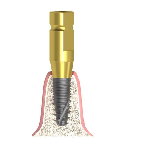 金属製印象用コーピング - Actival - Bionika Medline Kft. - ストレートタイプ / スクリュー / 滑らかな仕上げ