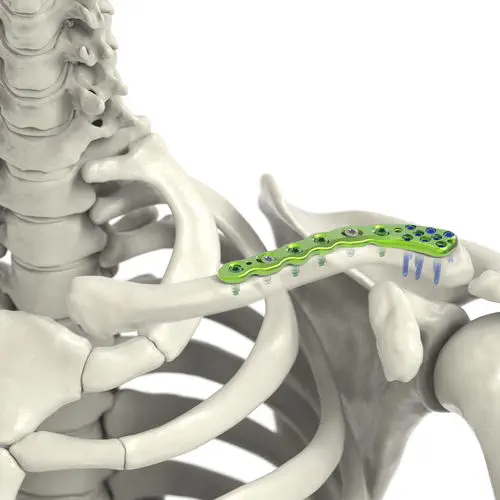 鎖骨用圧迫プレート - Jeil Medical Corporation - 側面 / 内側