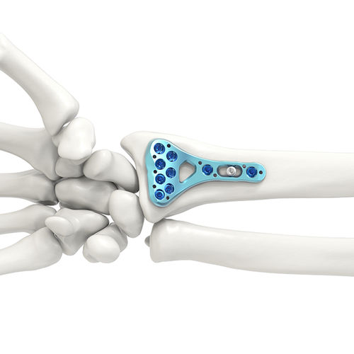 骨連結用の医療器具だと思います 橈骨用圧迫プレート - ARIX 2.5 - Jeil Medical Corporation - 末端