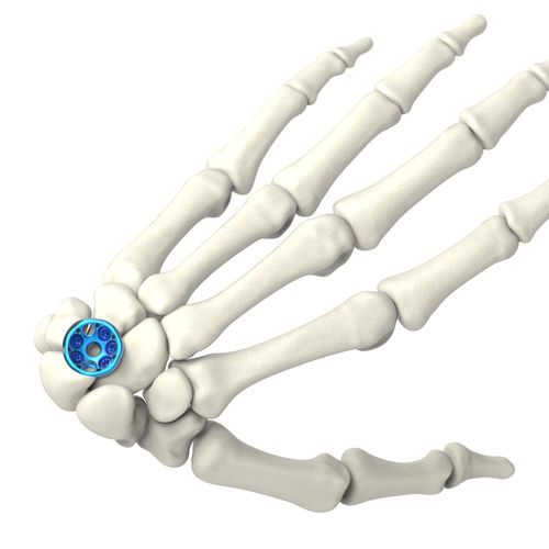 手根間関節用関節固定プレート - ARIX 2.5 - Jeil Medical Corporation - ロッキング / チタン製