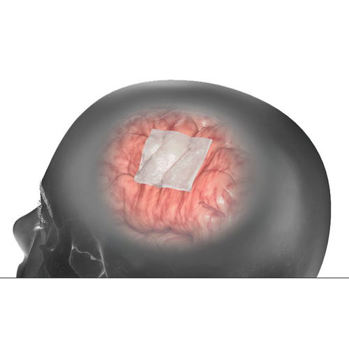ウシのアキレス腱用硬膜代用プロテーゼ - DuraMatrix  - Stryker