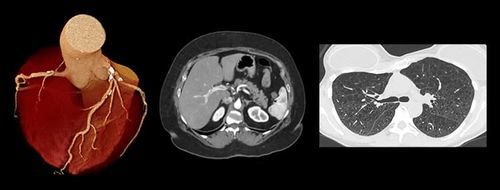 医療用ソフト - PIQE - Canon Medical Systems Europe - CT / 可視化 / 診断用
