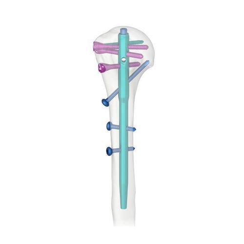 上腕骨用髄内釘 - AHN - Double Medical Technology - 近位固定 / 右 / 左側